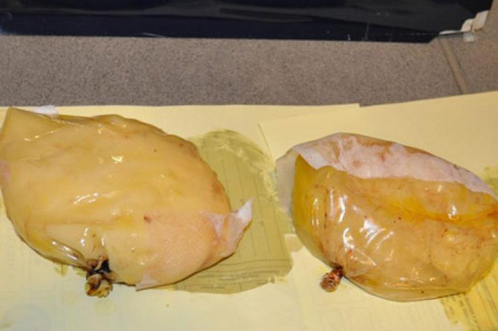 Woman carrying cocaine in breast implants arrested at Colombia airport | WeirdNews | Dunya News