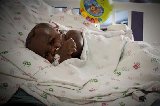 Docs Remove Parasitic Twin From Baby's Back Docs Remove Parasitic Twin From Baby's Back