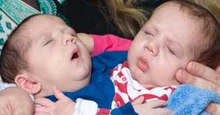 Doctors separate conjoined Irish twins