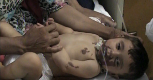 Faisalabad: 18 months old girl burnt by acid, quackster gave acid instead of medicine syrup