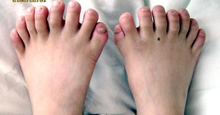 China: Successful surgery of 6 year boy to remove extra 11 fingers