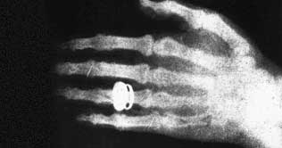 World marks 115th anniversary of discovery of X-Ray  