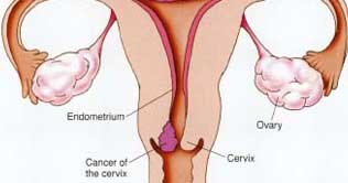 Cervical Cancer 3rd biggest death-cause for women