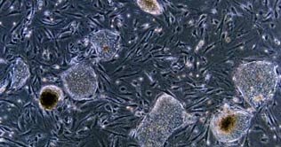 Embryonic stem cells tested on patient for first time