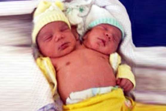 Rare two-headed baby born in Brazil