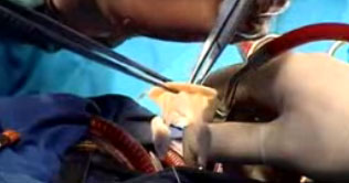 Russian doctors save girls life with animals valve