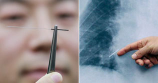 6.5cm acupuncture needle found from lung