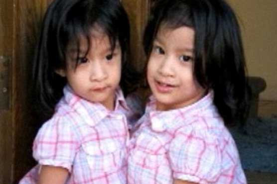 US girls joined at chest to be separated