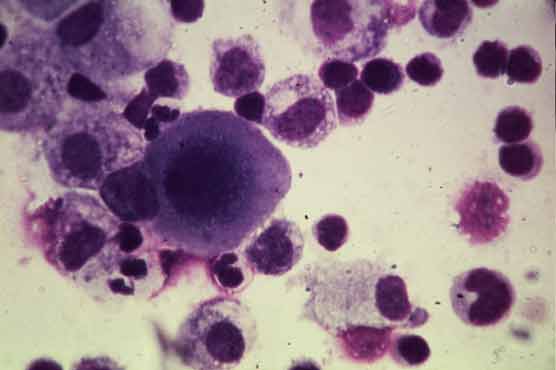 Scientists identify key protein that fuels cancer growth