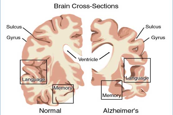 Potent vaccines can combat Alzheimer
