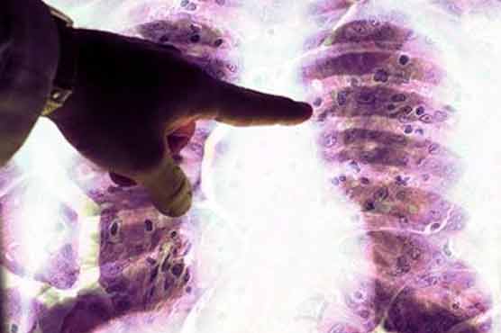 Gene causes lung cancer in non-smokers found