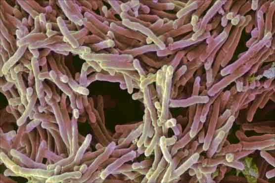 Karachi: gene expert machine to diagnose TB