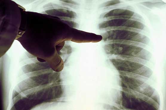Lung cancer screening with X-rays isn't beneficial
