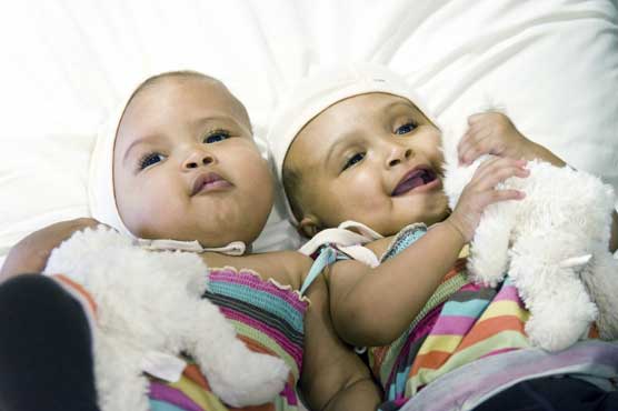 UK surgeons separate twin girls joined at head