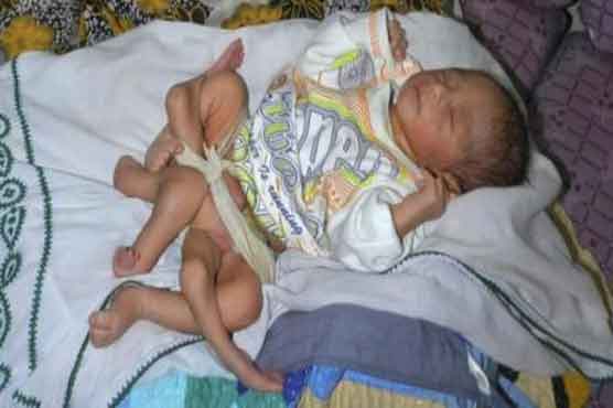 Doctors trying to save life of baby with six legs