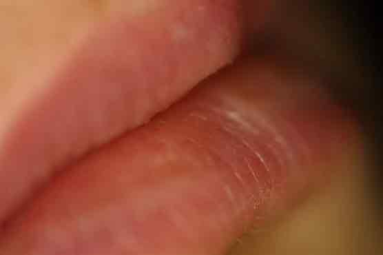 Blood pressure drugs may increase risk of lip cancer 