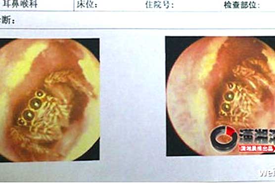 Hairy spider living in woman's ear for 5 days
