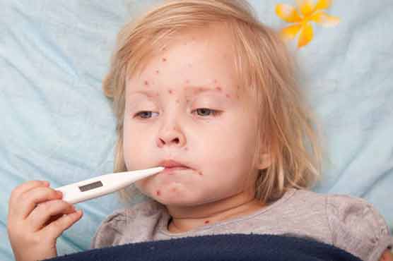 Chickenpox cases in US drop by 80pc in last decade