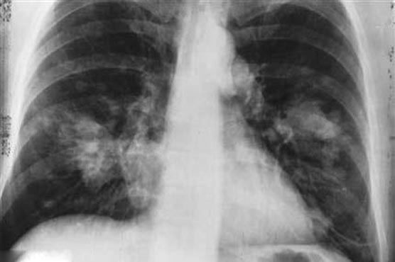 Drug resistant tuberculosis found across the world