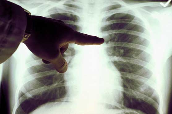 Study on mice shows fasting weakens cancer 