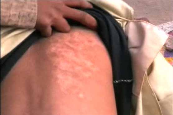 Fake pir scars children with cigarette stubs