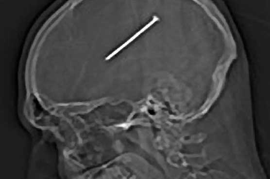 Lucky man lives after nail shot into head 