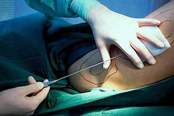 Obesity may increase after liposuction: Study