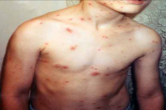  Mohmand Agency: six kids die of chicken pox 
