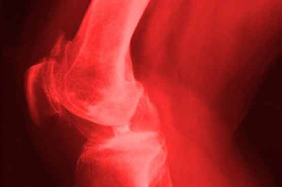 New way of treatment may stop arthritis spread