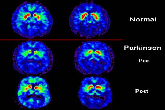 Potential cause of Parkinson’s disease identified  