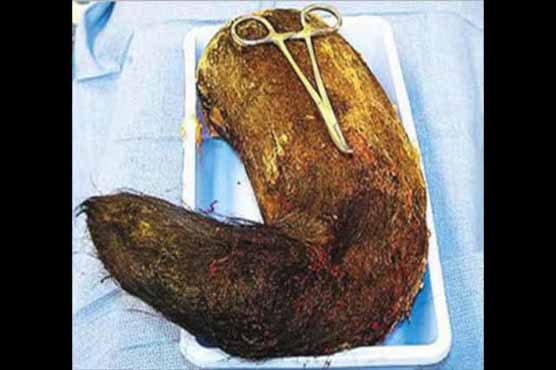 Doctors remove 4 pound hairball from a girl's stomach 