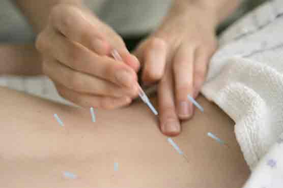 Placebo or not, acupuncture helps with pain: study