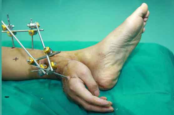 Severed hand sewed to man's ankle to keep it alive