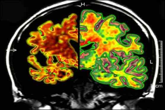 Space traveler can accelerate Alzheimer's: study