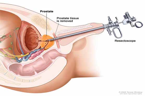 Stress cuts effectiveness of prostate cancer therapies