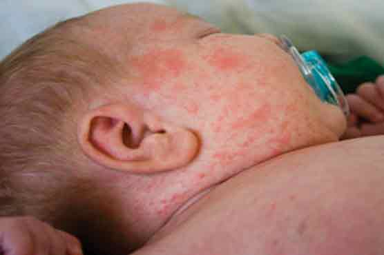 Three more kids die of measles in Faisalabad 