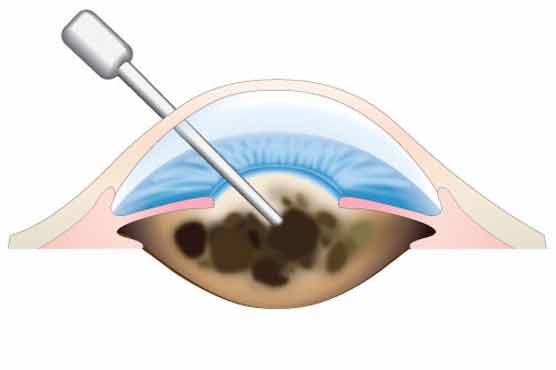 Breakthrough in sight for cataract treatment
