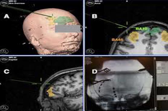 Scientists use brain electrodes to treat anorexia