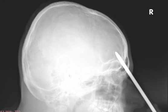 Doctors remove screwdriver from man's forehead