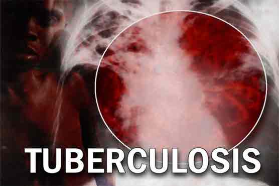Experts warn of untreatable TB risk