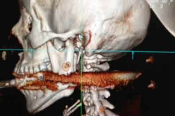 Woman survives harpoon shot through mouth
