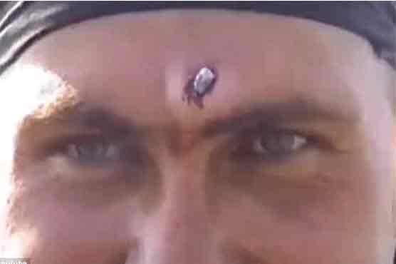 Pliers used to pluck off bullet from soldier’s head