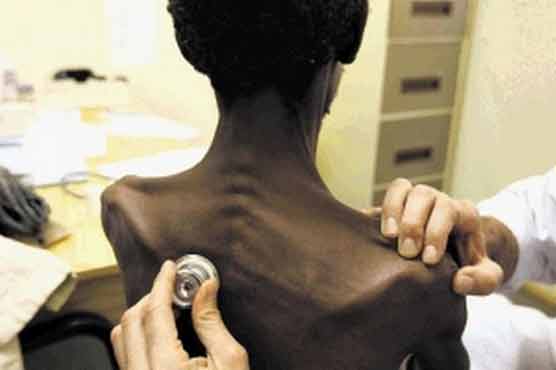 Tuberculosis claimed 1.3 million lives last year
