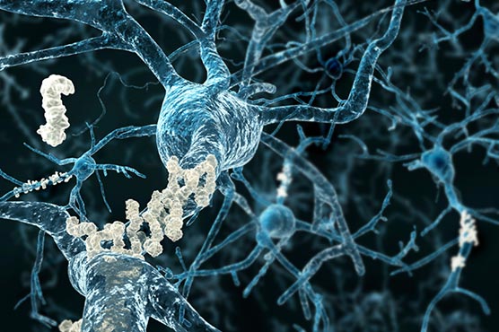 Japan study looks to big data for signs of Alzheimer's