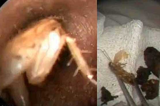 Cockroach burrows into man's ear