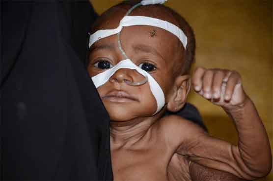Malnutrition kills over 3 million toddlers a year: UN