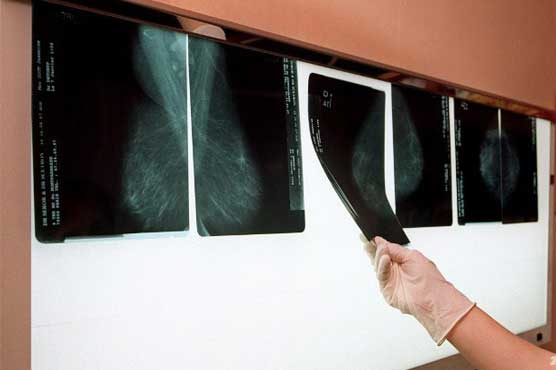 3D imaging detects more breast cancer than mammography