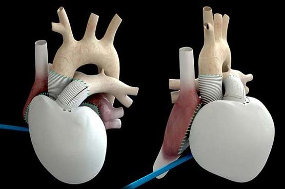Man with first artificial heart dies after 75 days