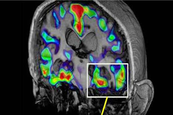 Study: Antidepressant may cut Alzheimer's protein