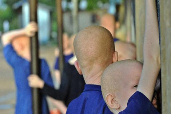 Malawi orders police to shoot those who attack albinos
